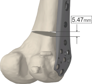 PreOperative Planning of Distal Femoral Open Wedge Osteotomy