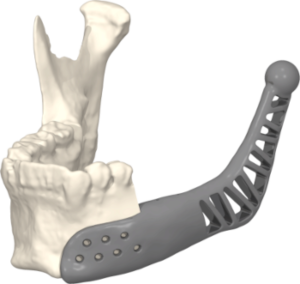 Mandibular Custom made prosthesis