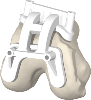 Patient Specific TKA Surgical Guide